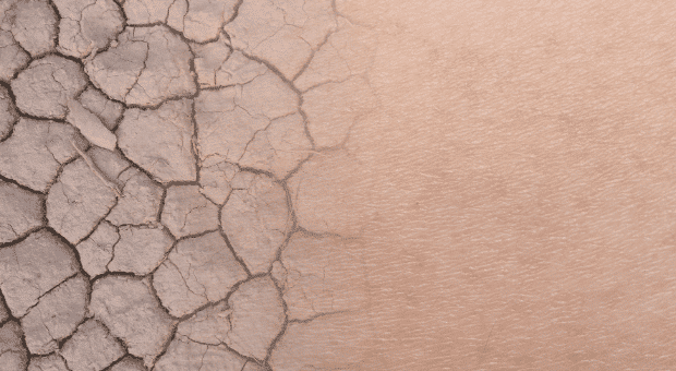 Trockene Haut im Winter vs. Wüstenboden