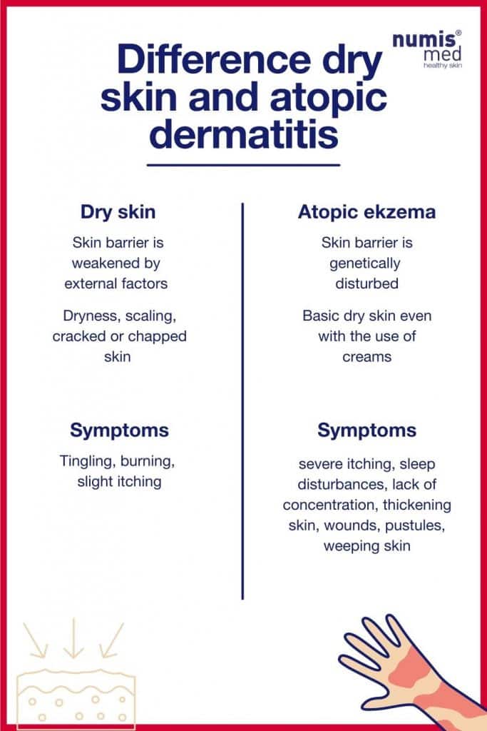 Difference dry skin and atopic dermatitis