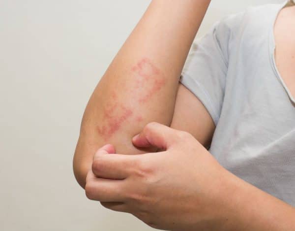 Frau mit Neurodermitis kratzt sich am Arm