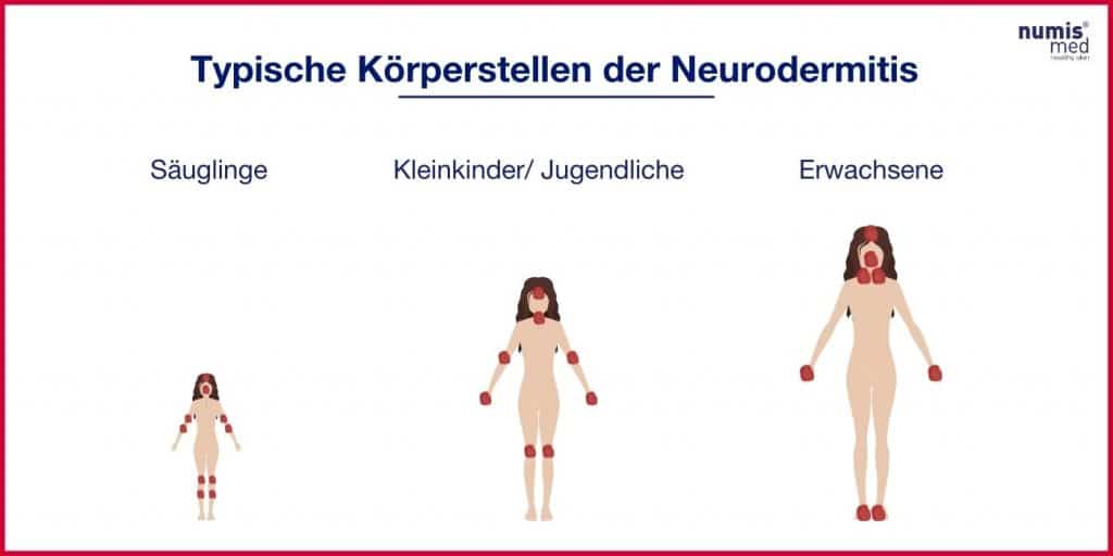Infografik Körperstellen der Neurodermitis