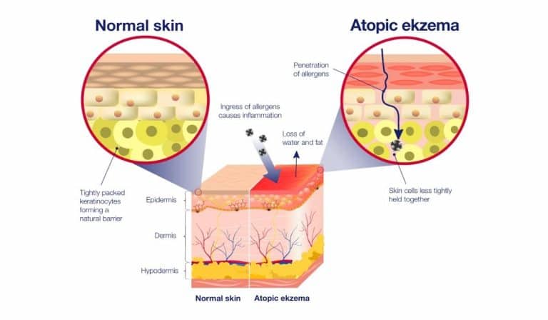 normal skin vs atopic ekzema infographic
